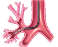 Nefes Darlığı Tedavisi Nefes Darlığı Tedavisi